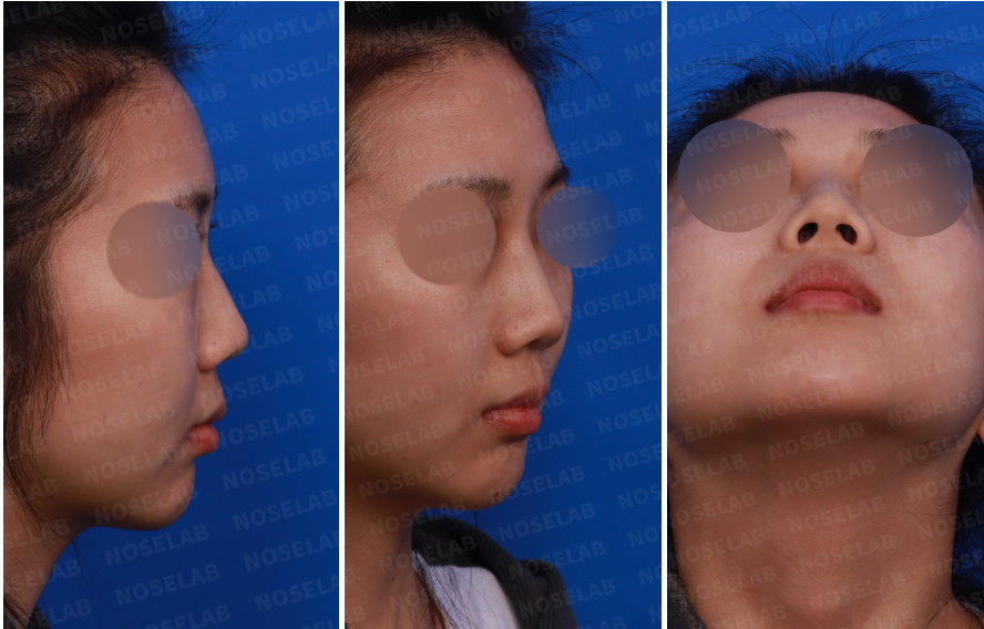 Preoperative design consultation photos showing the patient’s right side view, right oblique side view, and nostril view before closed rhinoplasty.