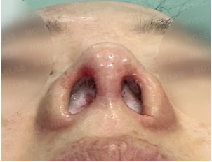 Immediate postoperative composite photo showing 45-degree, frontal, and nostril views. The images highlight the corrected nasal bridge, elevated nasal tip, improved columella shape, and reduced nostril asymmetry.