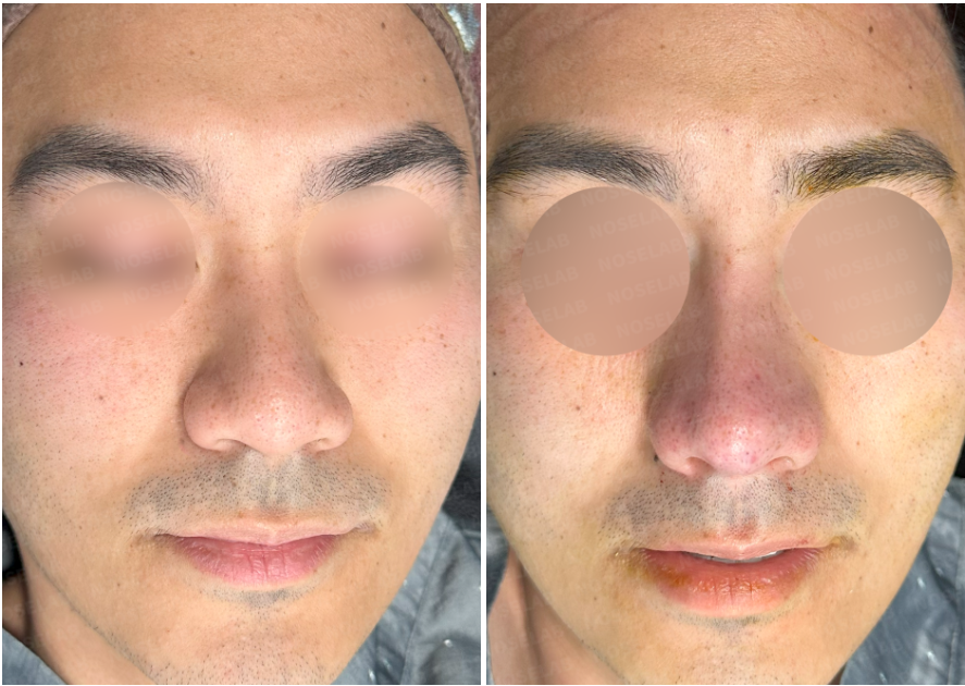 Before and immediately after frontal photos of a male patient undergoing rhinoplasty – left shows pre-op with bulbous nasal tip, right shows improved nasal tip definition and nostril symmetry