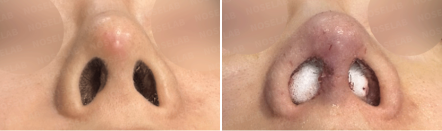 Basal view before and immediately after emergency revision rhinoplasty: correction of nostril asymmetry, improved columella support, and resolved implant exposure risk.