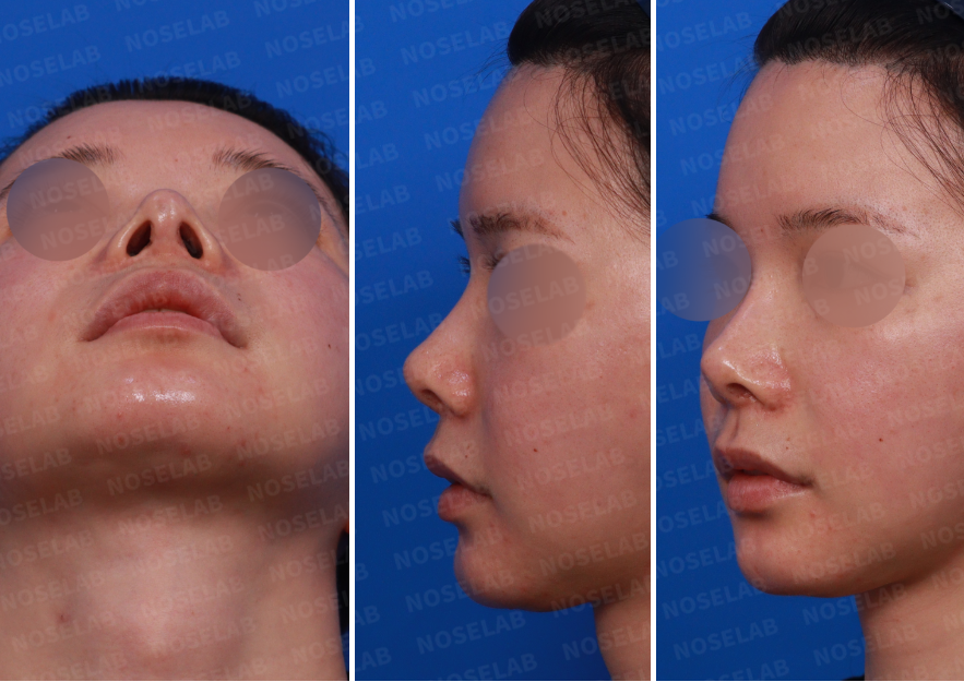 Preoperative consultation images showing right profile, oblique, and nostril views of a patient with nasal deviation and excessive nostril exposure prior to revision rhinoplasty.