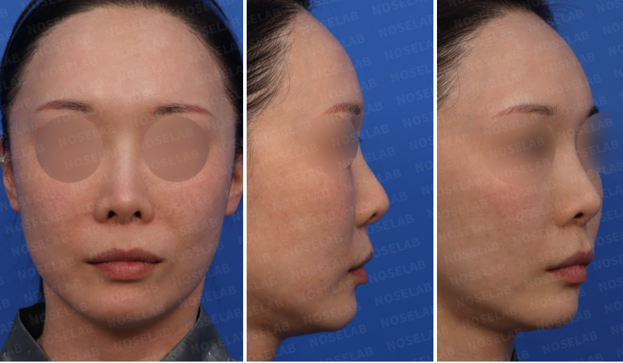 Revision rhinoplasty for short upturned nose – preoperative consultation photos showing frontal, side, and oblique views