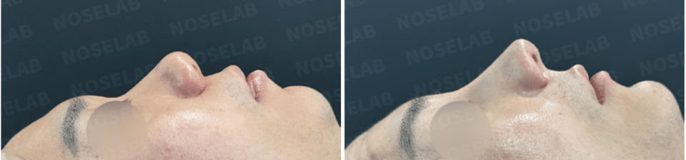 Before and after bulbous nose correction with chin surgery – side profile showing slimmer nasal tip, lowered columella, and more natural chin projection