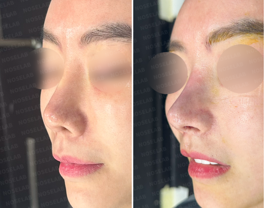 Repeated Dermal Absorption Nose Revision – Before (Left) and Immediately After Surgery (Right) Right Oblique Side View
