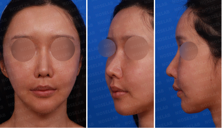 Rhinoplasty for long mid-face correction – preoperative consultation photos showing frontal, left oblique, and left side views