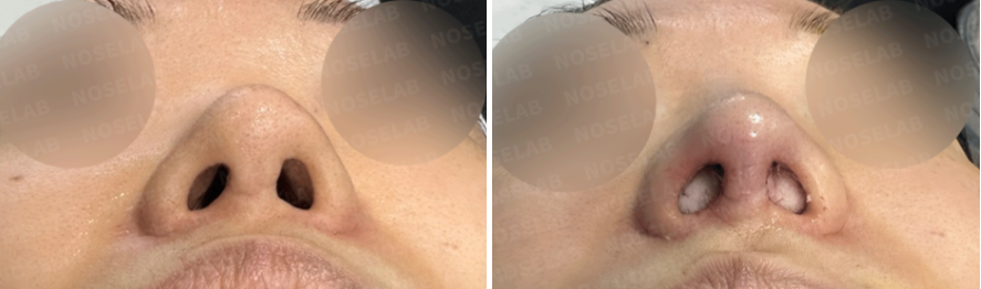 Nostril base view before surgery (left) and immediately after revision rhinoplasty correcting asymmetry caused by synthetic dermal graft absorption (right).