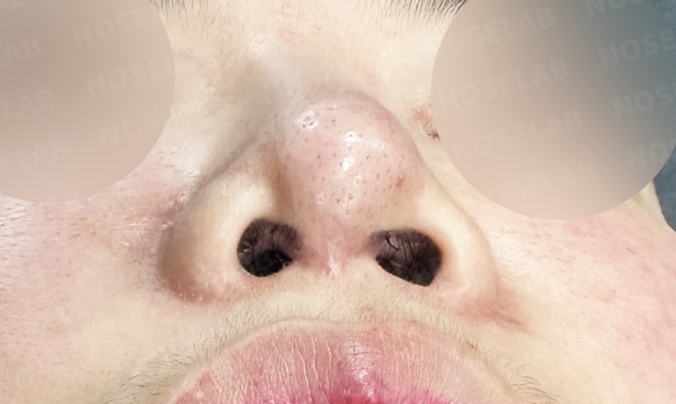 Before surgery: nostril view.
