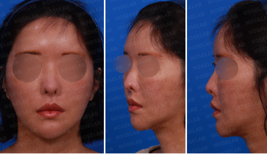 Corrective rhinoplasty after nostril reduction – preoperative consultation photos showing frontal, left oblique, and left side views
