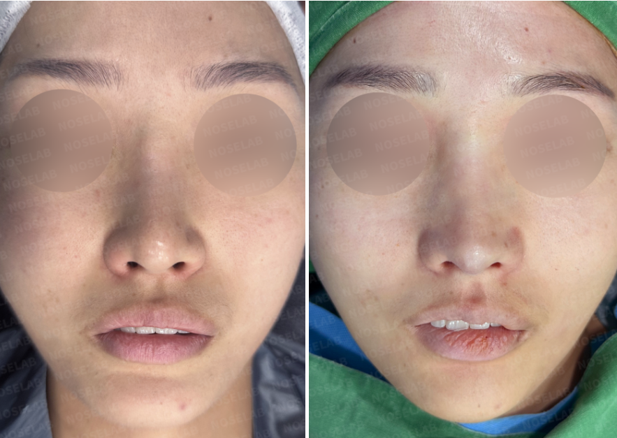 Before and immediately after frontal view showing improved nasal projection, refined tip position, and balanced midface proportions after revision rhinoplasty with autologous rib cartilage.