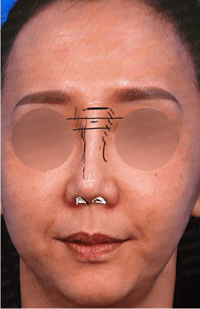 Frontal preoperative design photo showing high glabella, rightward nasal deviation, visible nostril asymmetry, and elongated nose before nose bridge starting point lowering surgery.