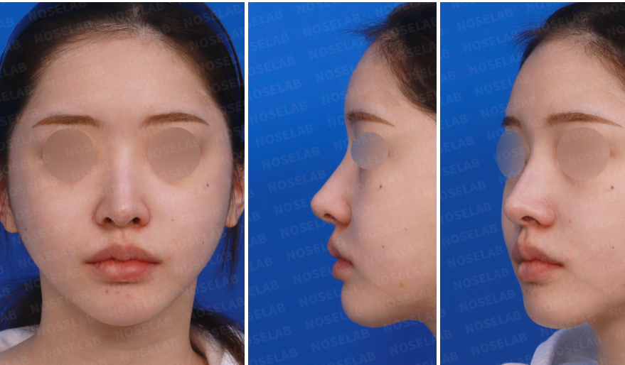 Preoperative design consultation photos for closed rhinoplasty Korea, showing frontal view, left oblique side view, and left side profile before nasal surgery, used to evaluate nasal structure, tip projection, and facial balance.