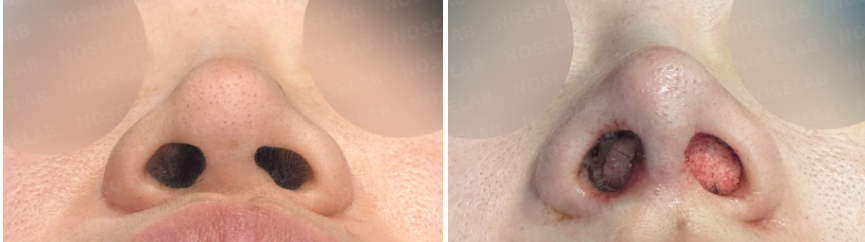 Nostril view comparison before (left) and immediately after (right) revision rhinoplasty showing exposure of reconstructed cartilage and correction of nostril asymmetry.