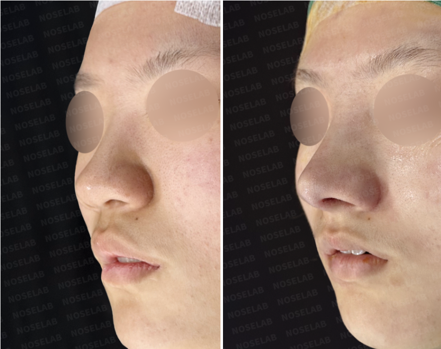 Before and immediately after surgery oblique view showing refined nasal tip contour, reduced bulbosity, and improved overall nasal definition following closed rhinoplasty with rib cartilage septal extension.