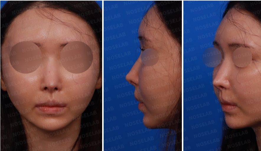 esign consultation photos before customized rhinoplasty for cartilage visibility – frontal, left side, and oblique views showing pointed nasal tip, visible tip cartilage, and slightly upturned nostrils.
