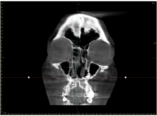 CT scan showing severe septal deviation to the right side, causing significant narrowing of the right nasal cavity.