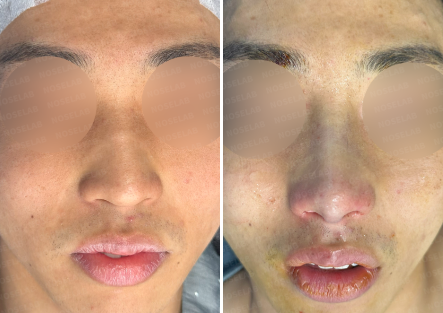 Frontal view photos before (left) and immediately after (right) surgery – showing nasal bridge and tip refinement with improved nostril symmetry