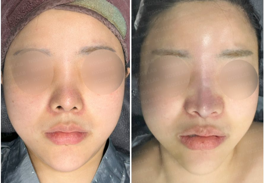 Frontal View Before and Immediately After Donor Rib Cartilage Revision for Wide Nasal Bridge and Upturned Tip