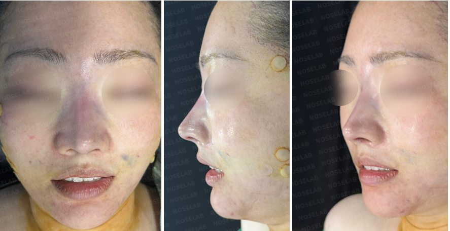 Postoperative view immediately after revision rhinoplasty – frontal, side, and oblique angles showing correction of nasal deviation and tip projection using rib cartilage.