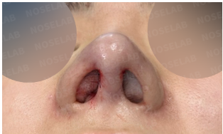 Immediately after nostril reconstruction surgery – base view showing nostril asymmetry correction with rib cartilage graft in closed rhinoplasty