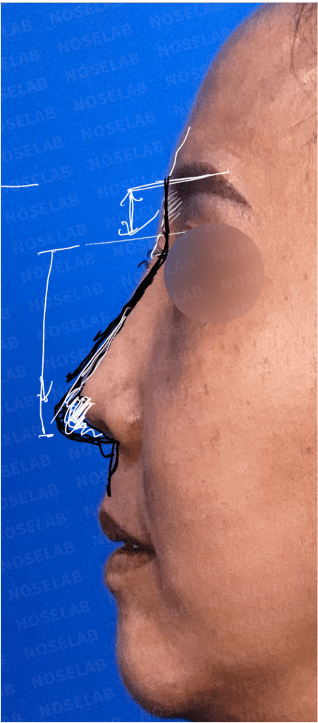 Side preoperative design photo showing unnatural forehead-to-glabella transition, short and droopy nose tip, retracted columella, and large nasolabial angle before nose bridge starting point lowering surgery