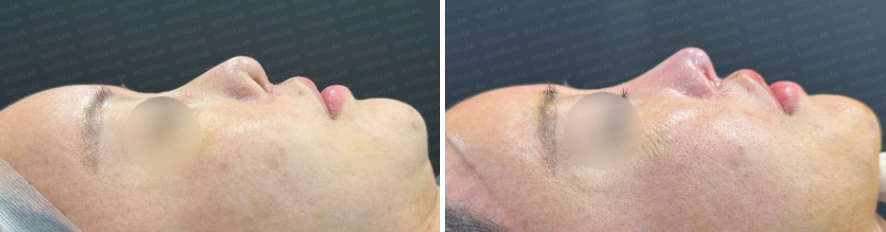 Corrective rhinoplasty after nostril reduction – before surgery (left) and immediate postoperative side view (right)