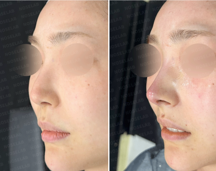 Correction of Drooping Nasal Tip and Nasal Obstruction – 45-degree oblique before and immediately after closed rhinoplasty at Nose Lab Clinic
