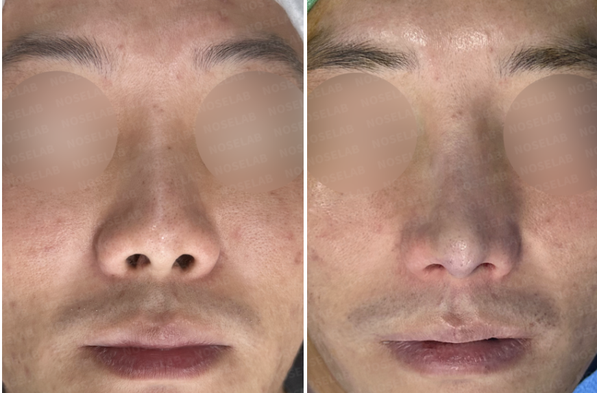 Before and immediately after frontal view following closed rhinoplasty Korea, showing improved nasal symmetry, corrected deviation, refined nasal tip, and stabilized nasal structure after contracted nose revision using autologous rib cartilage.