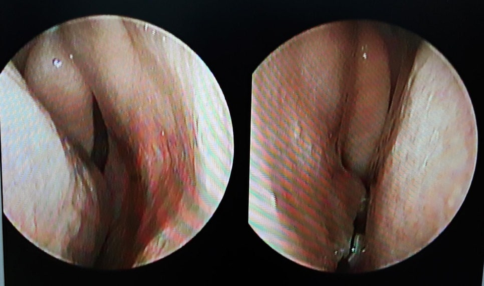Endoscopic images showing deviated nasal septum and hypertrophic rhinitis inside the nasal cavity.
