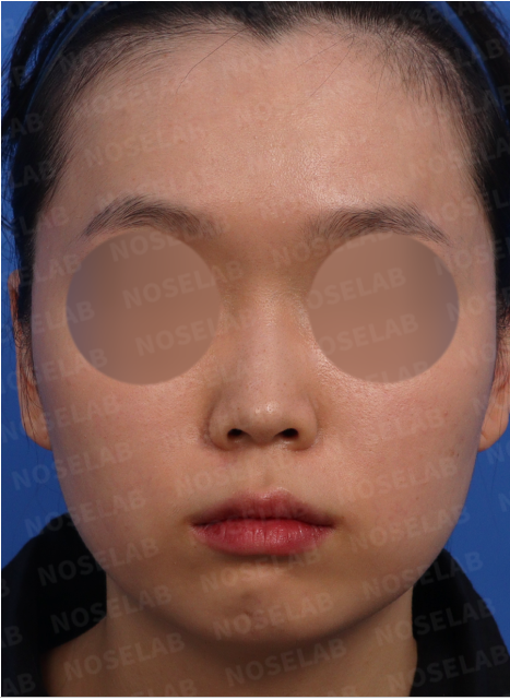 Short nose rhinoplasty – pre-surgery design consultation frontal view photo