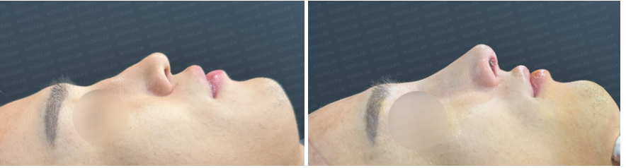 Before (left) and immediately after surgery (right) side view photos of a male patient, showing correction of crooked nose and improvement of the nasal bridge contour.