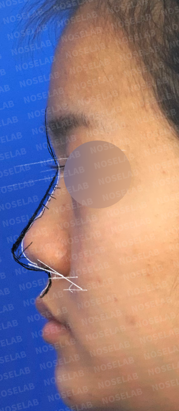 Surgical planning session showing lateral nasal profile assessment for tip refinement procedure