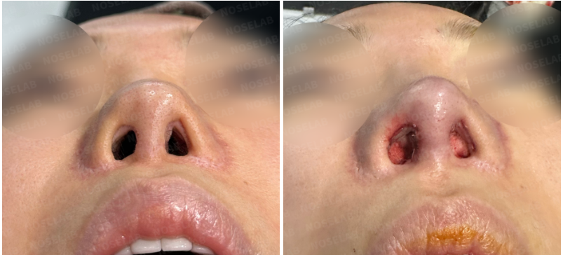 Nostrils before surgery (left) after surgery (right)
