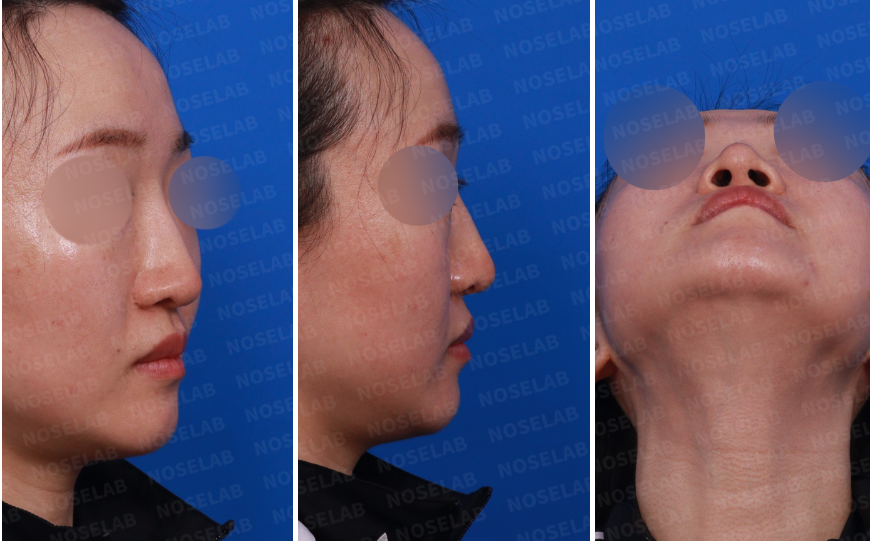 Preoperative images before bulbous tip correction: right profile, right oblique view, and nostril view showing columella deviation and nostril asymmetry.