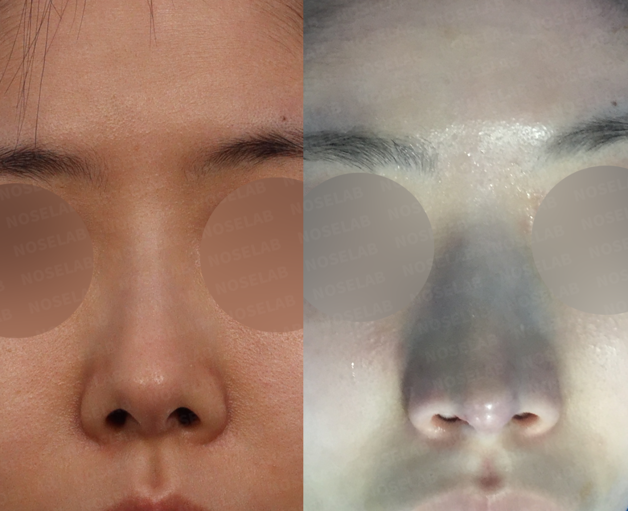 Frontal view demonstrating nostril symmetry improvement following comprehensive nasal reshaping surgery