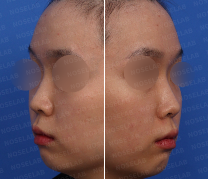 Short nose rhinoplasty – pre-surgery design consultation oblique 45-degree view photo
