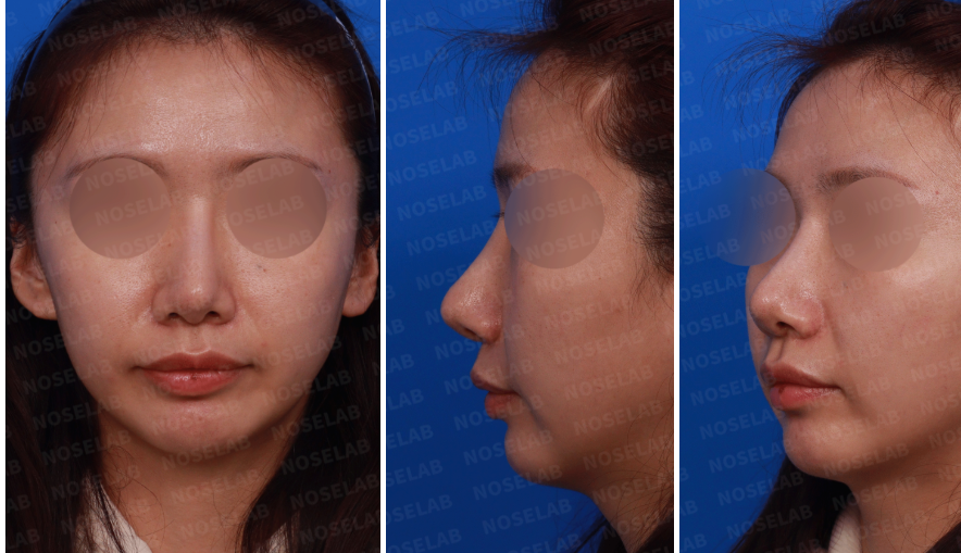 Preoperative design consultation photos of female patient for revision rhinoplasty: frontal view, left side profile, and left oblique view showing nasal deviation, bulbous tip, and dorsal irregularity