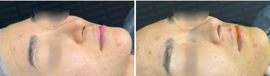 45-degree angle view before surgery (left) after surgery (right)