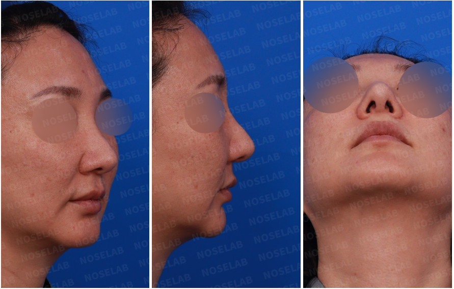 Design consultation photos before revision rhinoplasty after hump removal – right side, oblique, and nostril view showing nasal deviation and asymmetry.