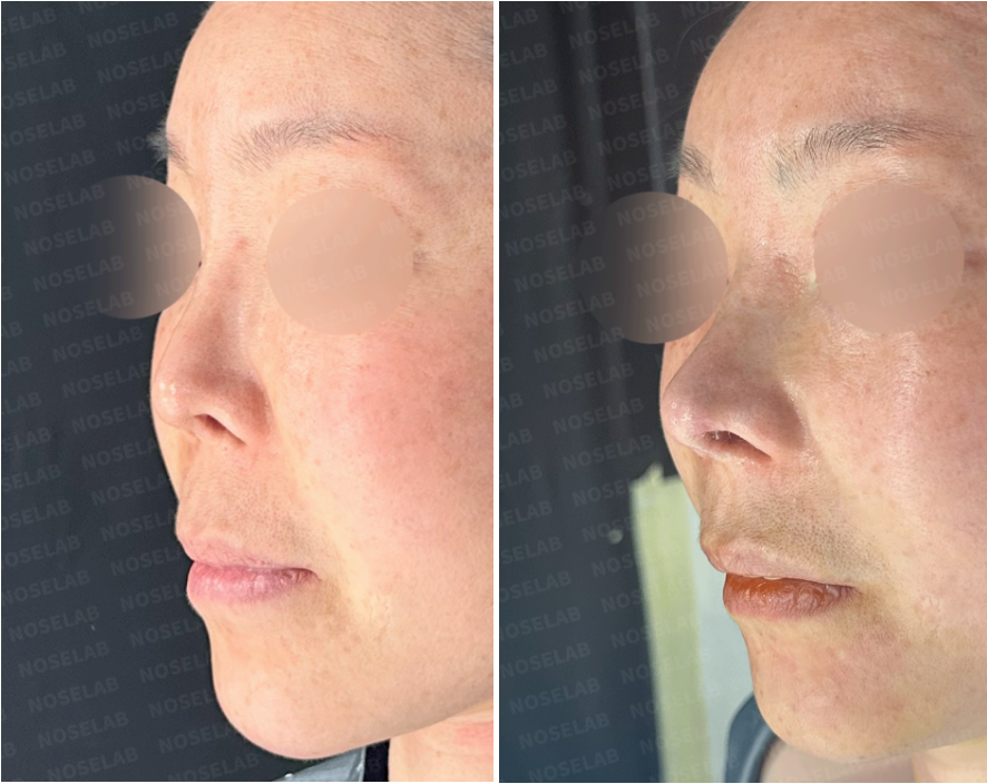 Oblique side view comparison of upturned nose correction: Before (left) and immediately after surgery (right) showing improved nasal tip rotation, reduced philtrum length, and balanced nasal-lip profile.