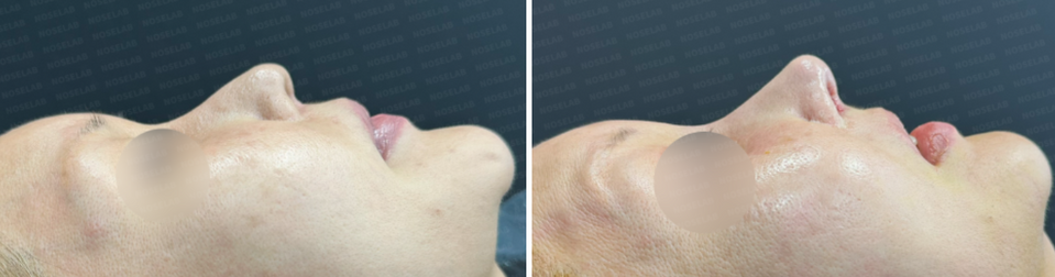 Side profile view before surgery (left) after surgery (right)
