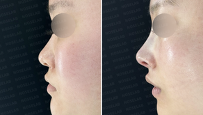 Closed rhinoplasty Korea – Side view comparison before and after surgery showing refined nasal tip projection using septal and ear cartilage grafts.