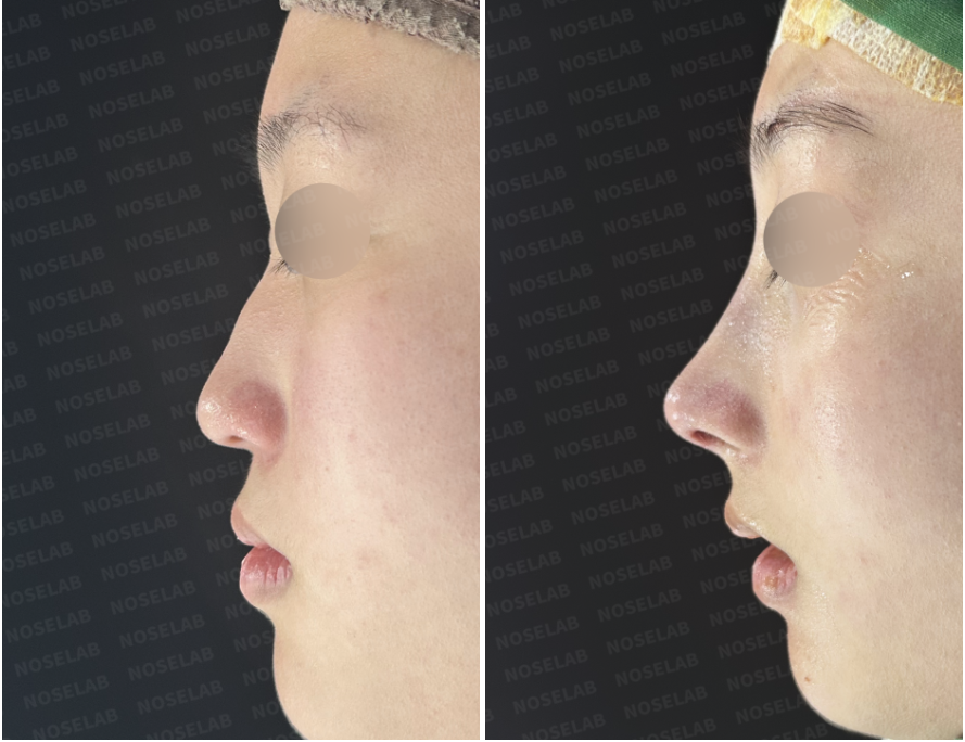 Before and immediately after surgery lateral view showing elevation of the drooping nasal tip, smoothing of the dorsal hump, and creation of a natural nasal profile following closed rhinoplasty with rib cartilage reconstruction and osteotomy.
