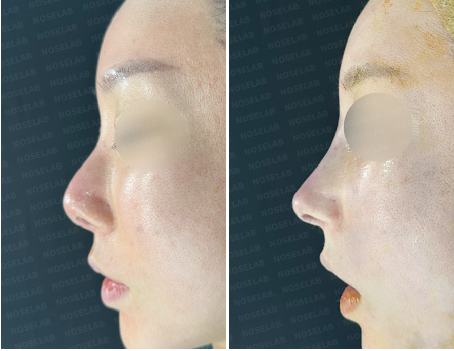 Side view before (left) and immediately after (right) revision rhinoplasty for severe nasal contracture and obstruction – showing improved nasal tip position and smoother dorsum.