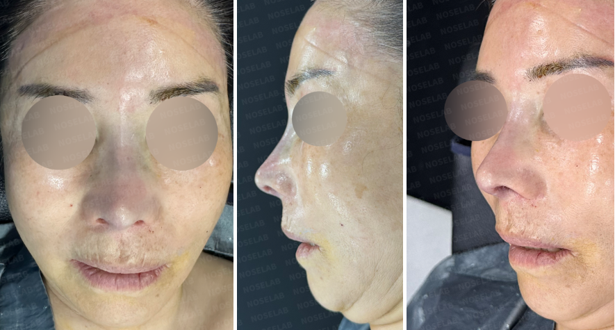 Postoperative frontal, side, and oblique side view photos immediately after rib cartilage reconstruction rhinoplasty at Nose Lab Clinic, showing corrected nasal structure and improved symmetry.
