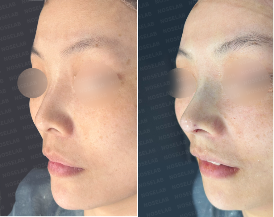 Before and immediately after primary rhinoplasty – oblique side view showing natural bridge height and balanced tip projection.