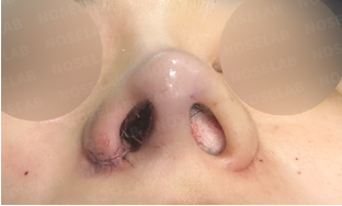 Post-Orthognathic Septal Reconstruction – immediate post-surgery nostril view showing septal support restoration and symmetrical nasal base after closed revision rhinoplasty
