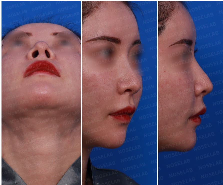 Pre-surgery consultation photos of a female patient: right oblique side view, right side view, and nostril view before revision rhinoplasty.