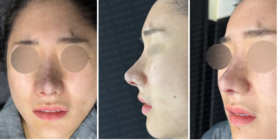 Immediately after revision rhinoplasty for nasal contracture – frontal, oblique side, and side views showing enhanced nasal symmetry and contour.