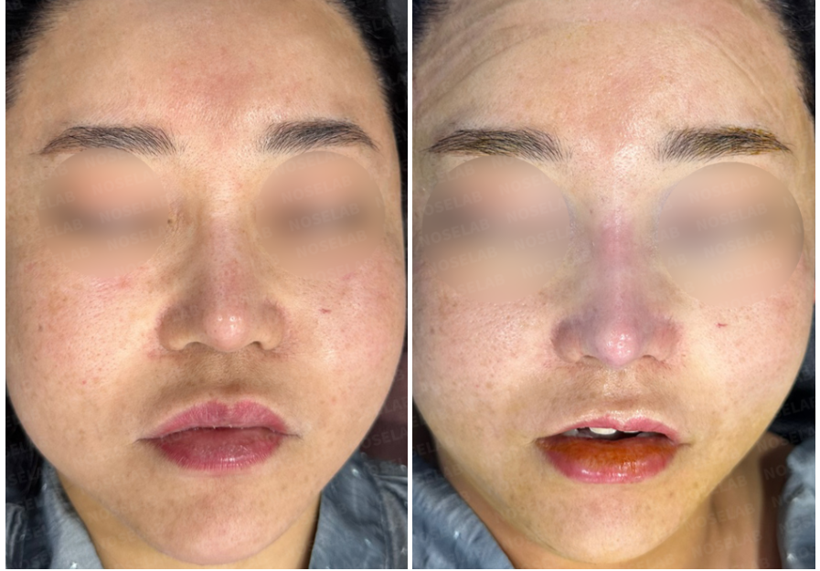 Frontal view before (left) and immediately after (right) nasal septum reconstruction surgery