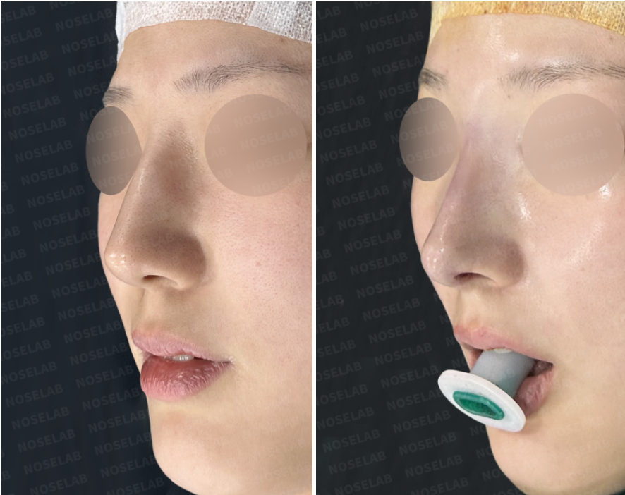 Before and immediately after surgery oblique view showing a straighter nasal bridge and refined nasal tip following revision closed rhinoplasty with lateral osteotomy and autologous rib cartilage.